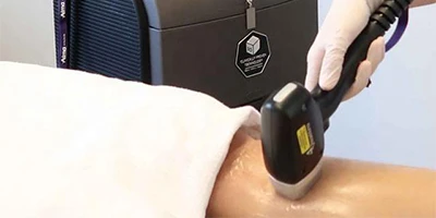 Laser Hair Removal